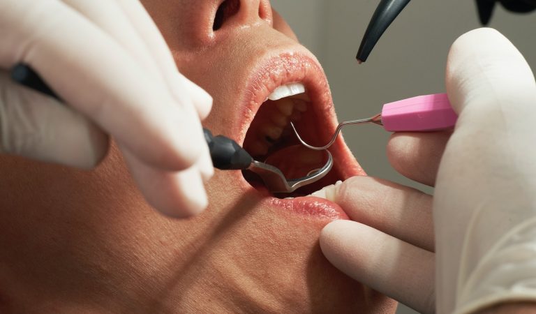 Care sunt cele mai bune materiale pentru implanturi dentare